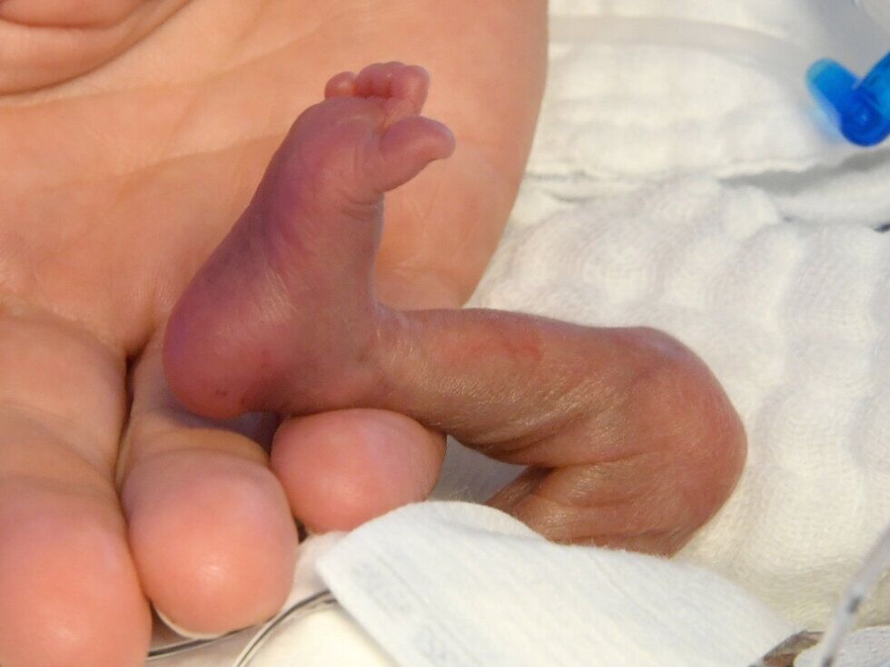 V bolnišnici v Bolzanu zaradi bakterijske okužbe umrla dva nedonošena otroka, začasno ustavili rizične porode