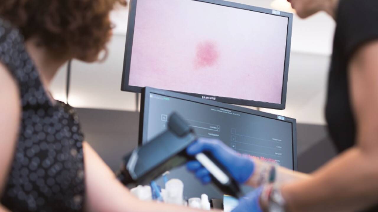 Bei der Hautkrebsvorsorge werden Muttermale kontrolliert. Verdächtige Hautveränderungen können einfach entfernt werden. 