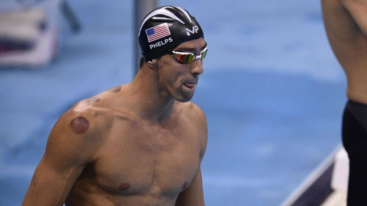 Schröpfen: Dunkle Flecken auf Körper von Olympiasieger Phelps