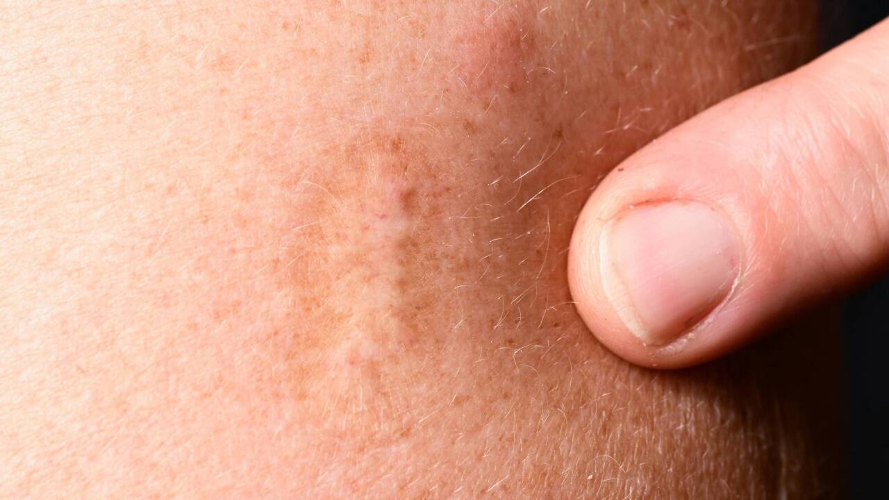 Eine Narbe einer Pockenimpfung ist an einem Oberarm sichtbar. Die Pocken zählten lang zu den gefährlichsten Krankheiten überhaupt für den Menschen. Impfstoffe brachten die Rettung, seit 1980 gilt die Welt als pockenfrei. Eine Narbe einer Pockenimpfung ist an einem Oberarm sichtbar. Die Pocken zählten lang zu den gefährlichsten Krankheiten überhaupt für den Menschen. Impfstoffe brachten die Rettung, seit 1980 gilt die Welt als pockenfrei.