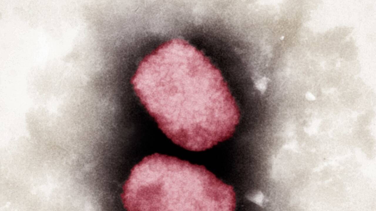 Das Affenpockenvirus ist für die WHO eindämmbar 