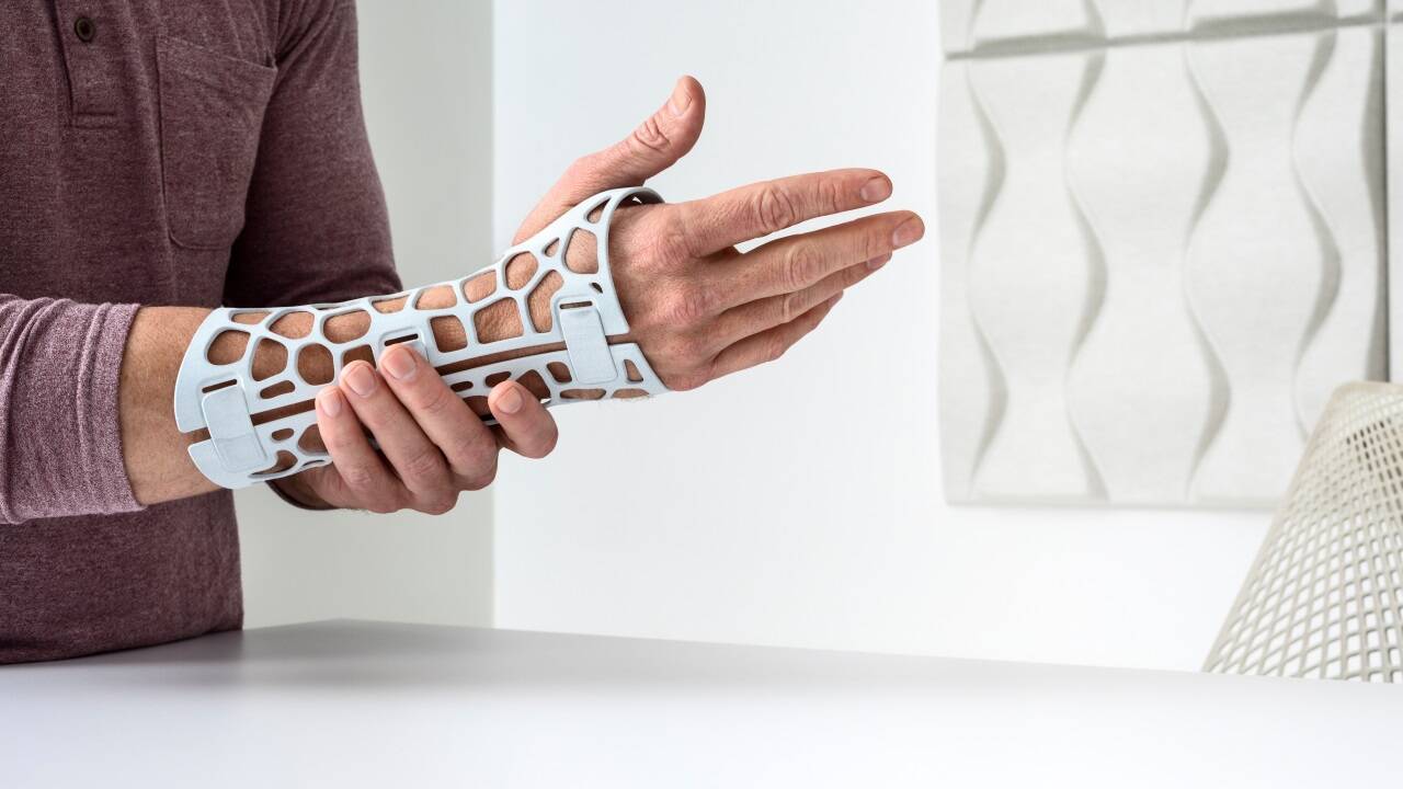 3D-Handschiene statt Gips. 3D-Handschiene statt Gips.