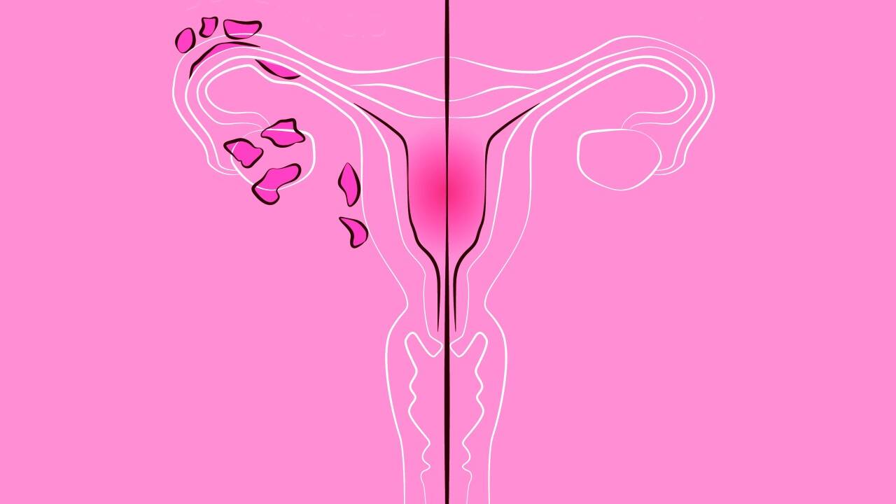 Links setzen sich ob der Endometriose Zysten am Uterus fest, rechts ist der Uterus Endometriose-frei. 