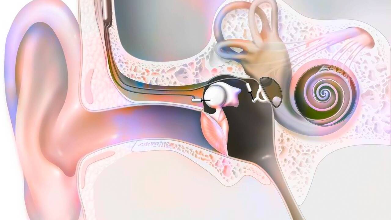 Das CI-System besteht aus einem Sprachprozessor plus Mikrofon, an dem eine Sendespule mit Magnet angebunden ist. Die Elektroden des Implantats werden in die Cochlea (Hörschnecke) eingeführt. Die Empfangsspule wird im Schädelknochen nahe der Ohrmuschel unter der Haut platziert.   Das CI-System besteht aus einem Sprachprozessor plus Mikrofon, an dem eine Sendespule mit Magnet angebunden ist. Die Elektroden des Implantats werden in die Cochlea (Hörschnecke) eingeführt. Die Empfangsspule wird im Schädelknochen nahe der Ohrmuschel unter der Haut platziert.