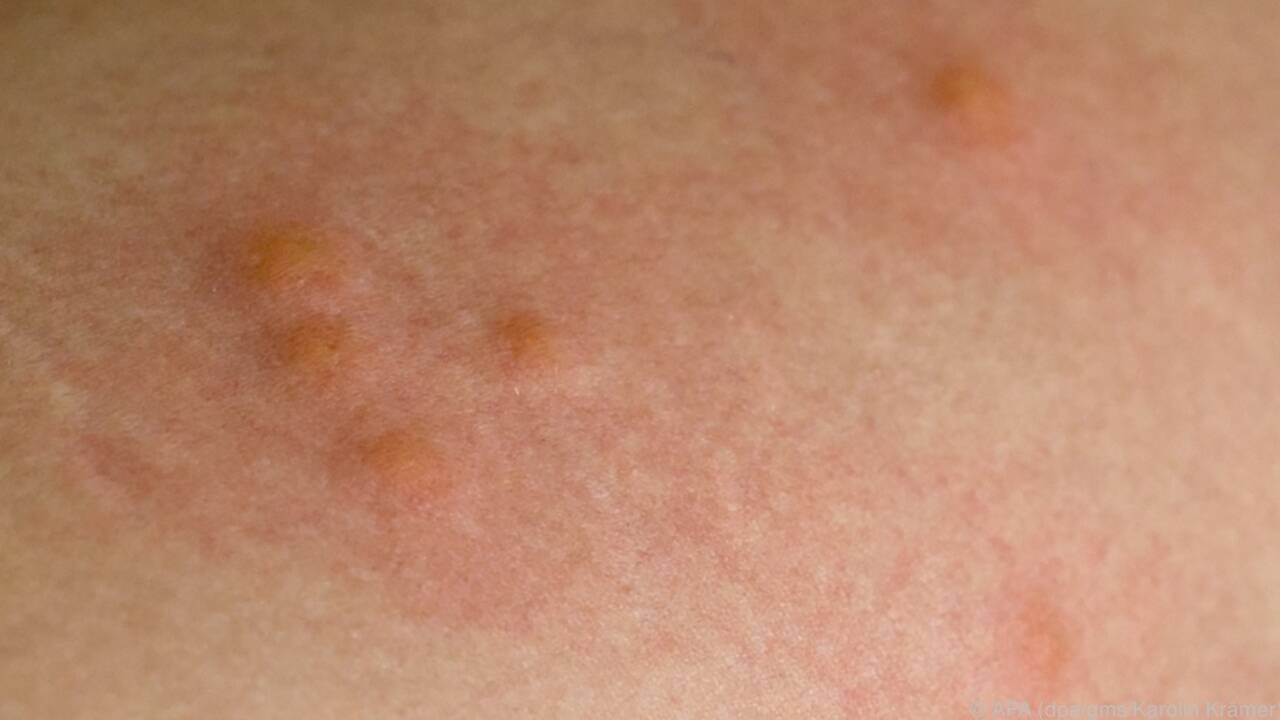 Gelsenstiche können stark jucken - trotzdem sollte man nicht kratzen.  