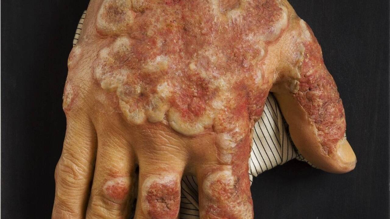 Rötungen und Entzündungen der Haut zeigt diese Moulage aus dem Jahr 1908.  