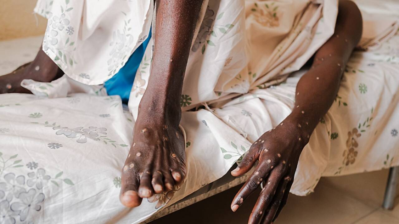 Mpox breitet sich in Afrika immer weiter aus  Mpox breitet sich in Afrika immer weiter aus