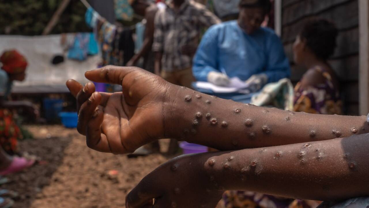 Die Mpox bleiben in Afrika ein großes Problem.  