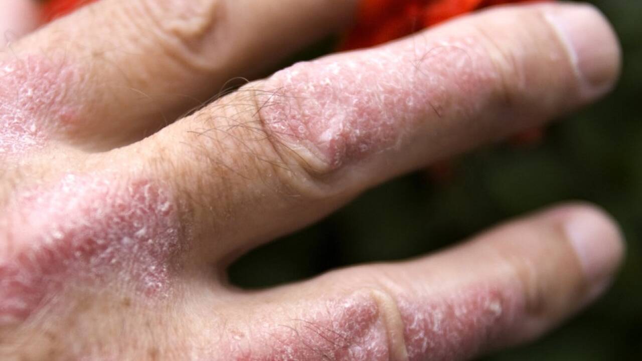 Schuppenflechten sind eine weit verbreitete Erkrankung.   Schuppenflechten sind eine weit verbreitete Erkrankung.