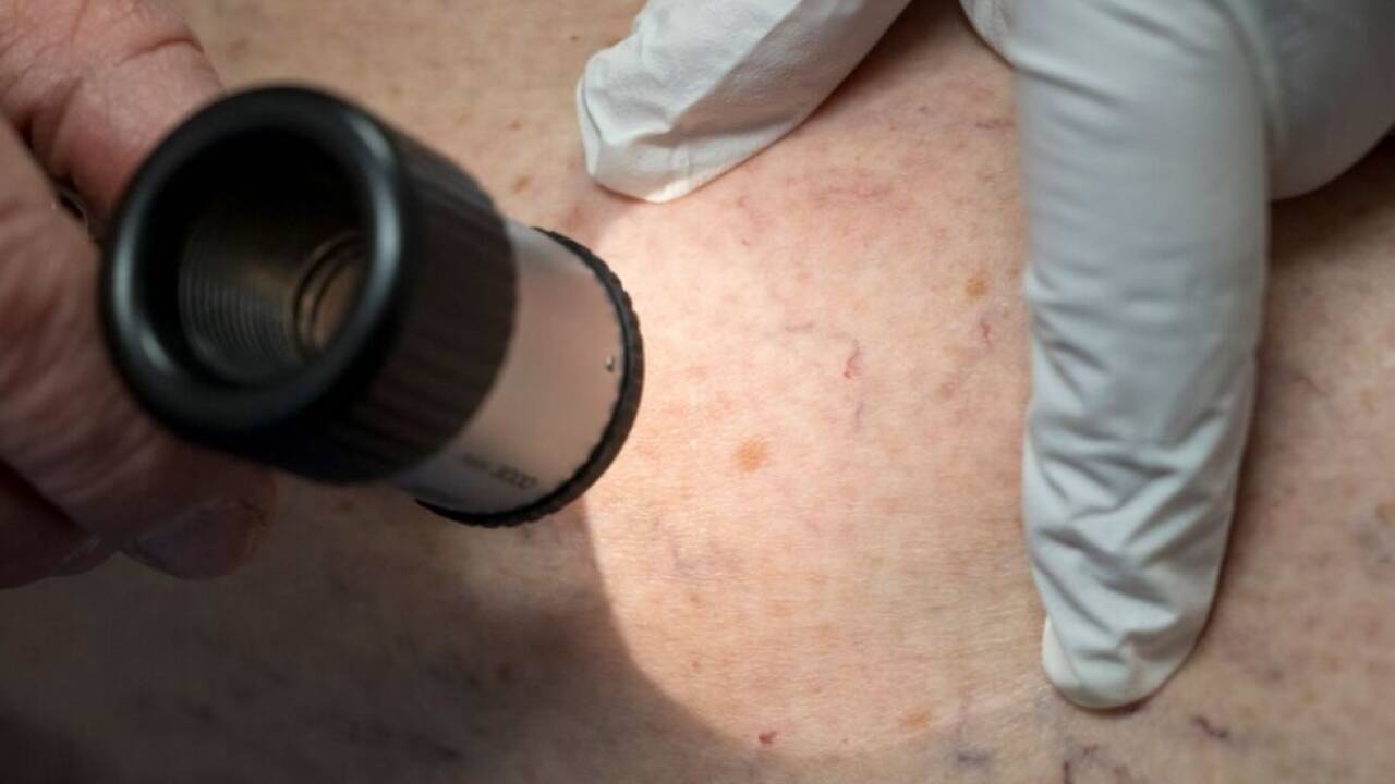 Hautuntersuchung: Ärzte wollen mehr Geld 