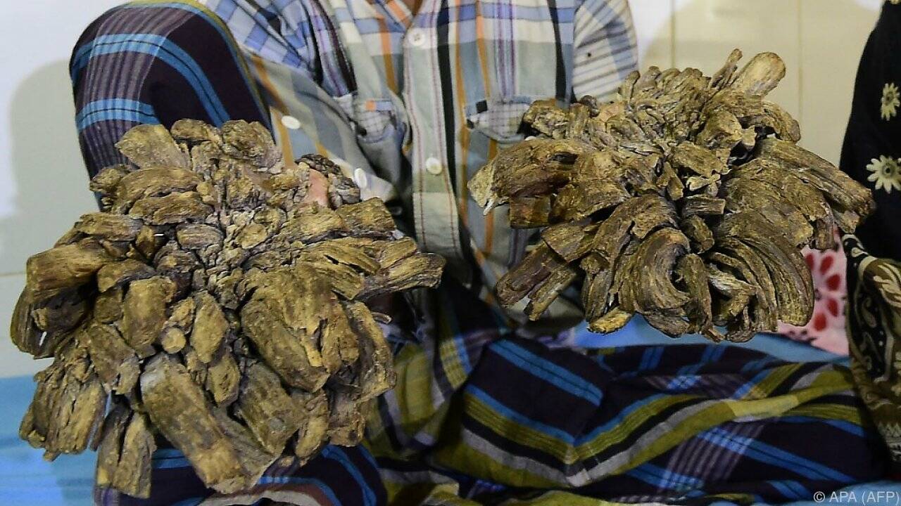 Bangladeschs "Baum-Mann" wird kostenlos operiert