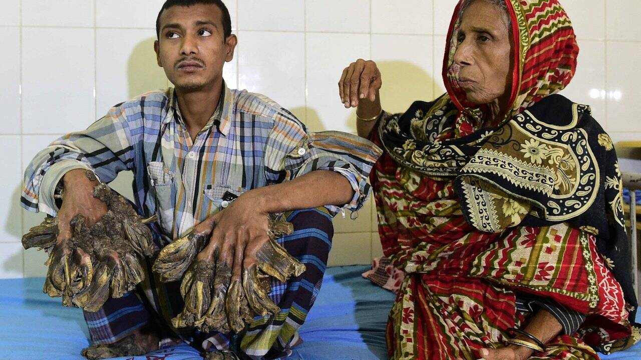 Bangladeschs "Baum-Mann" wird kostenlos operiert
