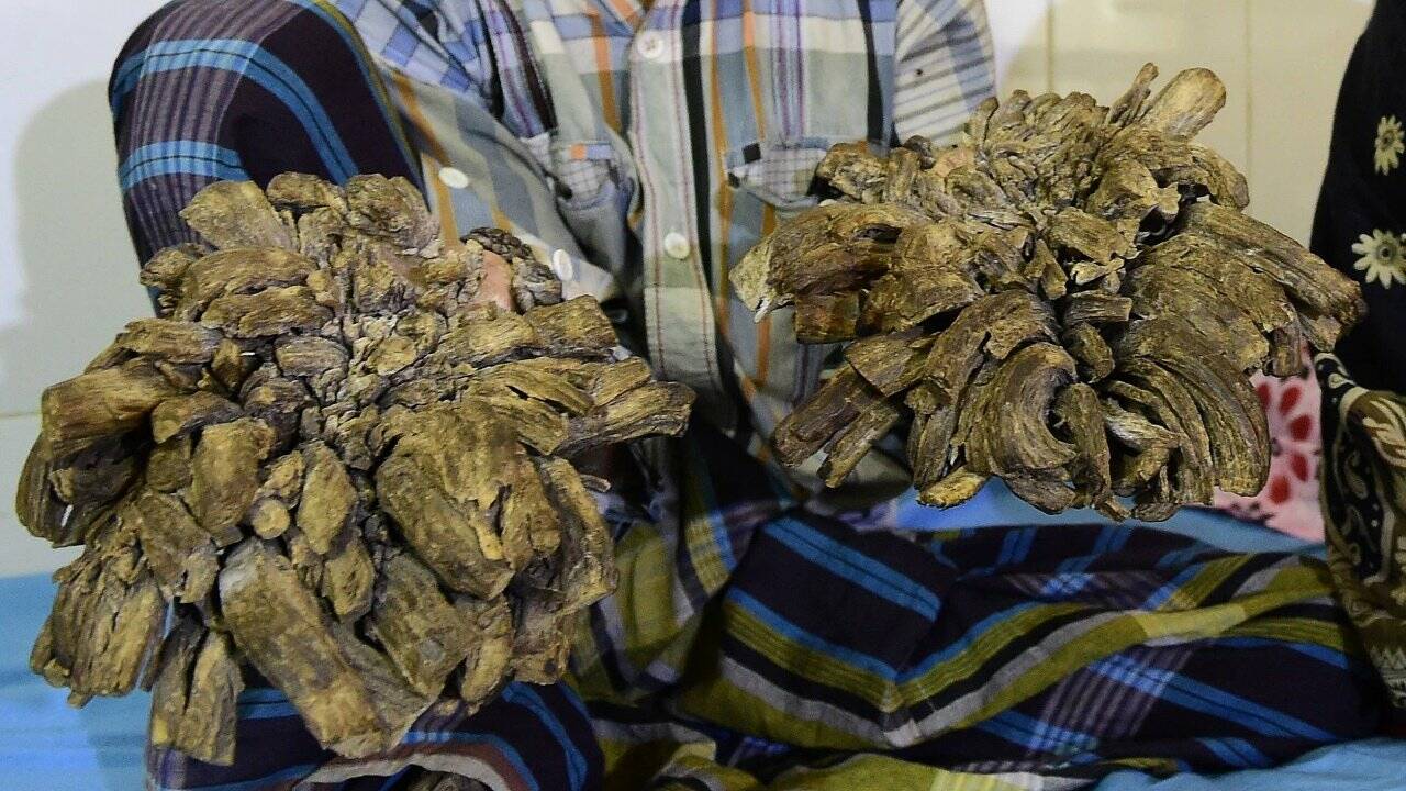 Bangladeschs "Baum-Mann" wird kostenlos operiert