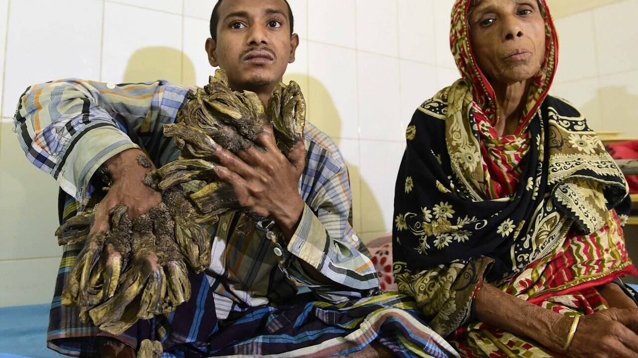 Bangladeschs "Baum-Mann" wird kostenlos operiert