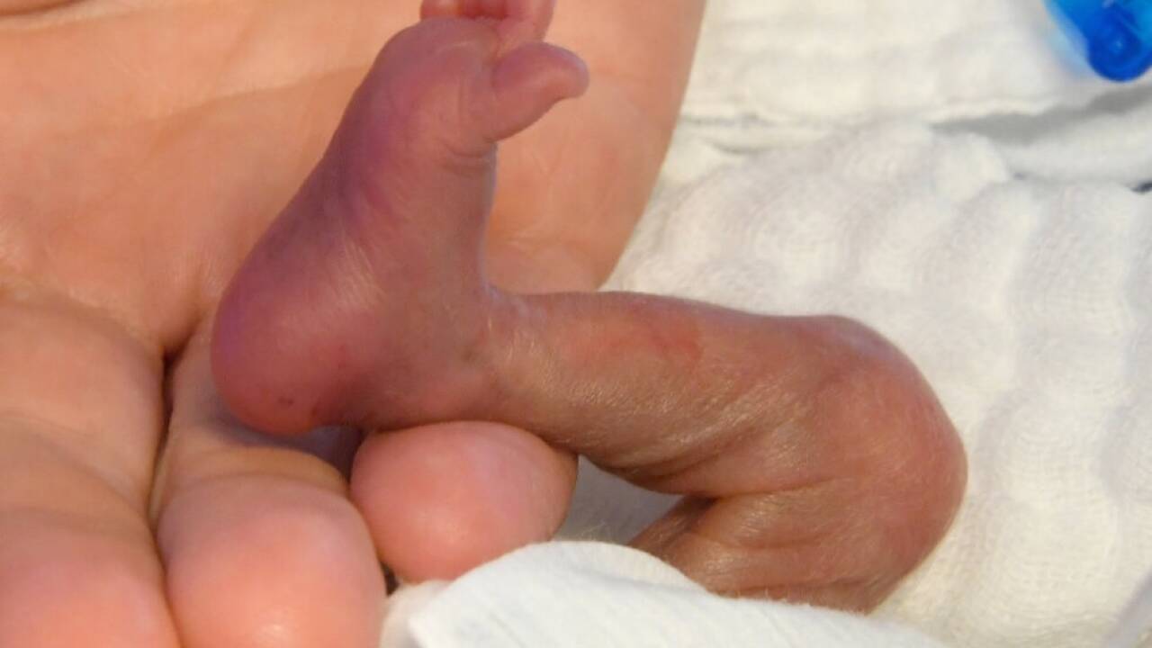 Zwei Frühchen starben in Bozen an den Folgen einer Bakterien-Infektion 