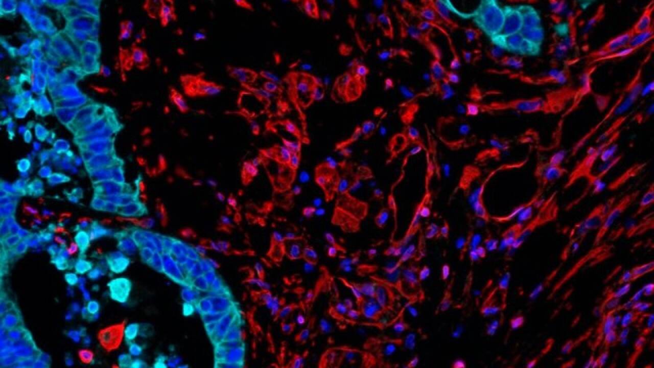 Die Immunfluoreszenz-Aufnahme zeigt eine Anhäufung fibrotischer, sauerstoffarmer Regionen (rot) am Tumorrand.  