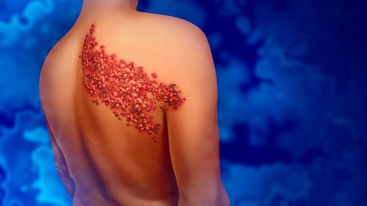 Der schmerzende Hautausschlag betrifft nur eine Hälfte des Körpers. Der schmerzende Hautausschlag betrifft nur eine Hälfte des Körpers.