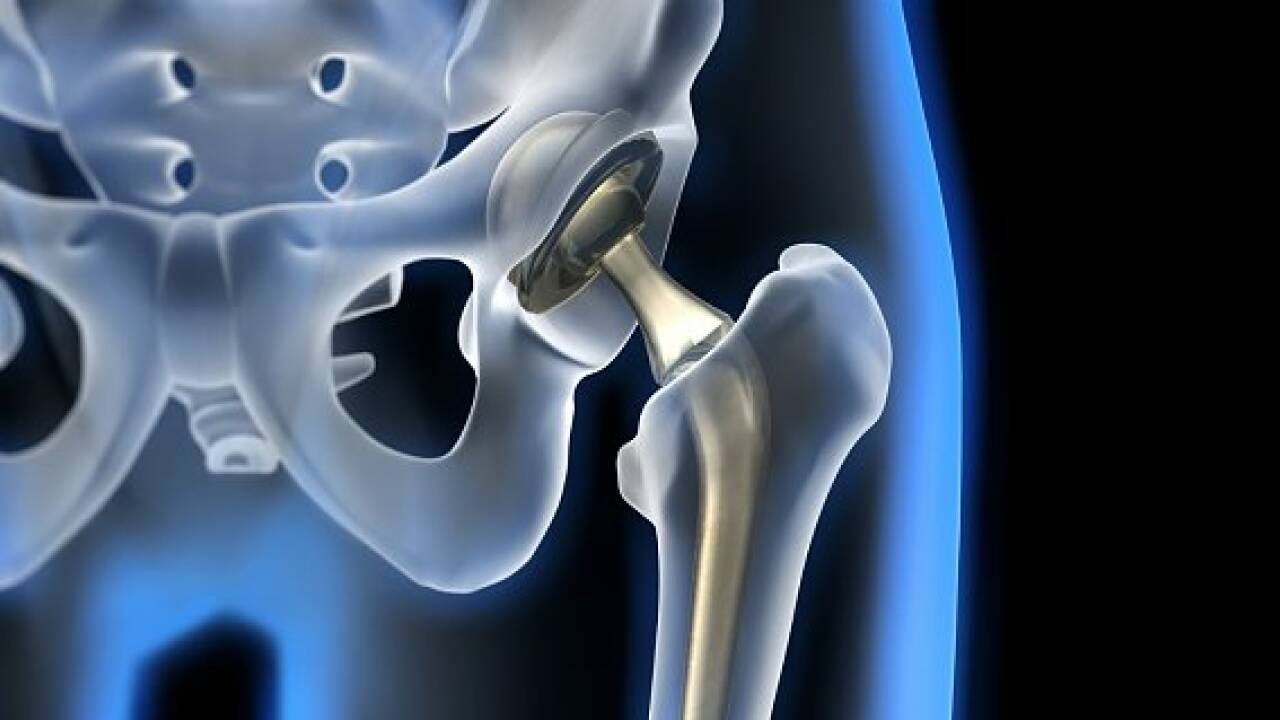 Arthrose: Neue Therapiemöglichkeit in Aussicht