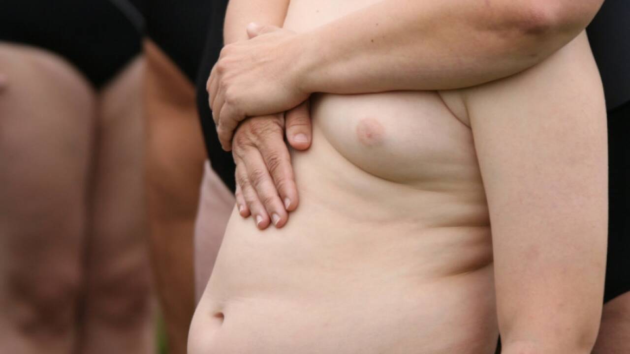Weltweit leiden 124 Millionen Kinder unter Adipositas 