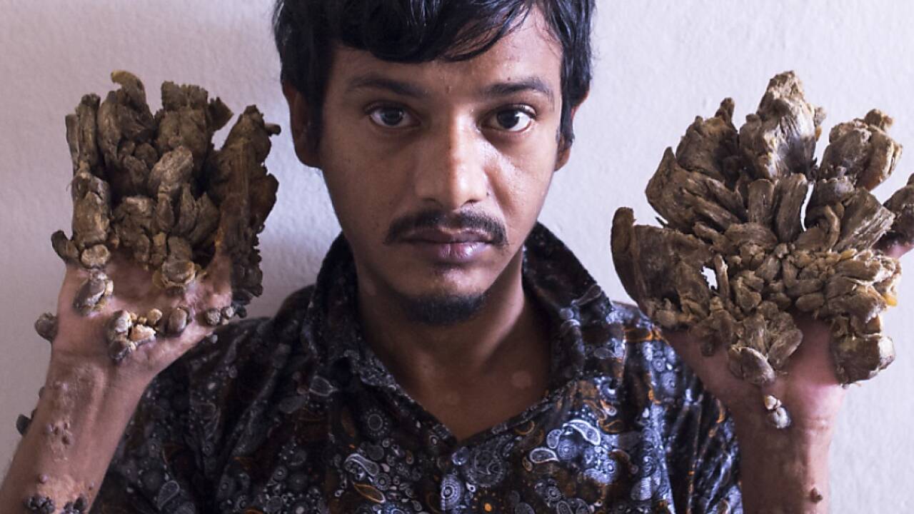 'Tree Man' Abul Bajandar aus Bangladesch 
