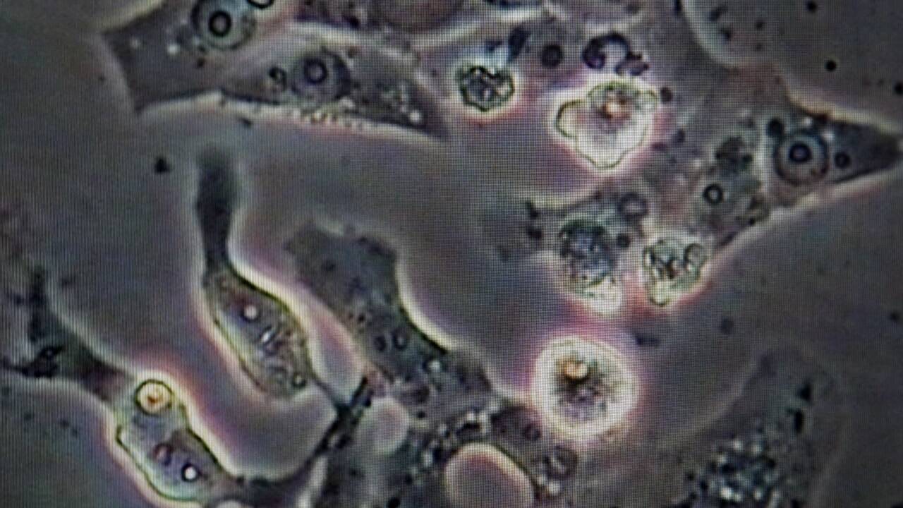 Viren sind nicht nur im Menschen, sondern auch in Pflanzen und Tieren wie hier in der Amsel zu finden. Der Bildschirm eines Mikroskops zeigt in Hamburg im virologischen Labor des Bernhard-Nocht-Instituts fuer Tropenmedizin durch das Usutu-Virus zerstoerte Zellen in der Zellprobe einer Amsel. Viren sind nicht nur im Menschen, sondern auch in Pflanzen und Tieren wie hier in der Amsel zu finden. Der Bildschirm eines Mikroskops zeigt in Hamburg im virologischen Labor des Bernhard-Nocht-Instituts fuer Tropenmedizin durch das Usutu-Virus zerstoerte Zellen in der Zellprobe einer Amsel.