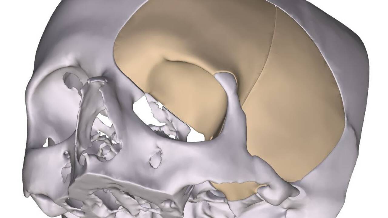 Ein 19-köpfiges Team des Uniklinikums Salzburg verband bei einer Tumor-OP am Schädel erstmals moderne Navigation, Bildgebung und 3D-Druck.  