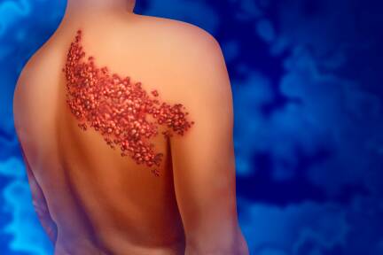 Der schmerzende Hautausschlag betrifft nur eine Hälfte des Körpers. 